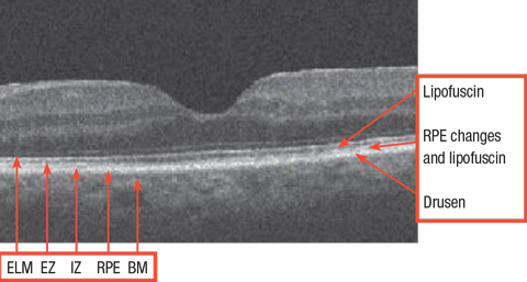 Normal retina with relevant structures noted. ELM: external limiting membrane. EZ: ellipsoid zone. IZ: interdigitation zone. RPE: retinal pigment epithelium. BM: Bruch’s membrane.