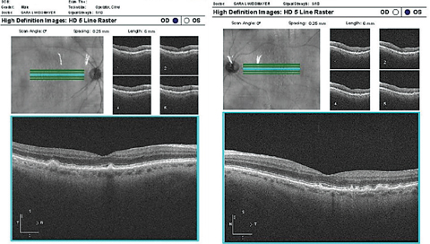 These OCT images show typical drusen in dry AMD. Notice that the drusen are under the RPE.