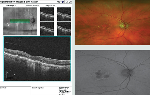 Notice the hypo-AF on FAF associated with the GA, and some patchy surrounding hyperf-AF surrounding the GA in the OCT, color photo and FAF image of this patient with AMD with GA and drusen. On OCT, the obvious drusen is posterior to the RPE, as expected, and the atrophy involves the RPE and outer retina.