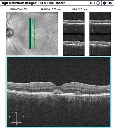 OCT in an AFVM patient showing two lesions with vitelliform material anterior to the RPE, the larger (more central) of the two with an underlying lucent space.