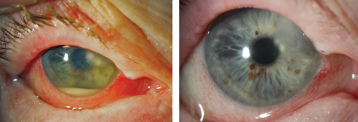 When an ulcer requires steroids, they should be introduced cautiously. This Moraxella catarrhalis ulcer, at left, was treated for one week with medication that it was sensitive to (per culture results) and improved, but only slowly. It wasn’t until a steroid was cautiously introduced that the eye totally quieted, at right. In this case, having a culture result in hand to ensure appropriate antimicrobial treatment made the subsequent addition of a steroid a reasonable step to take.  
