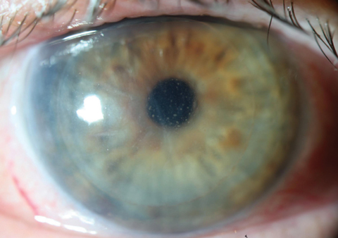 A rejection of a DSAEK graft manifesting as corneal edema and scattered keratic precipitates. This appearance also approximates that seen with viral endotheliitis; in both cases, topical steroids are indicated.