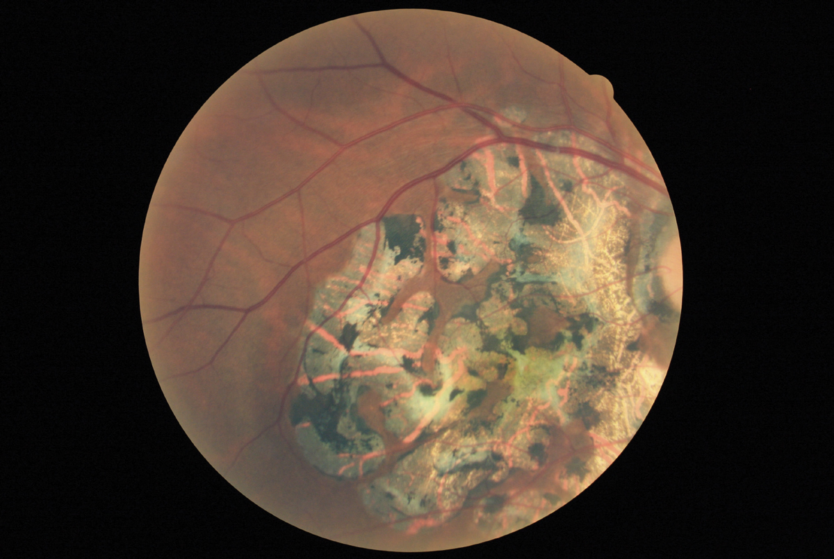 This fundus photograph of inactive serpiginous choroiditis shows classic RPE and retinal atrophy. 