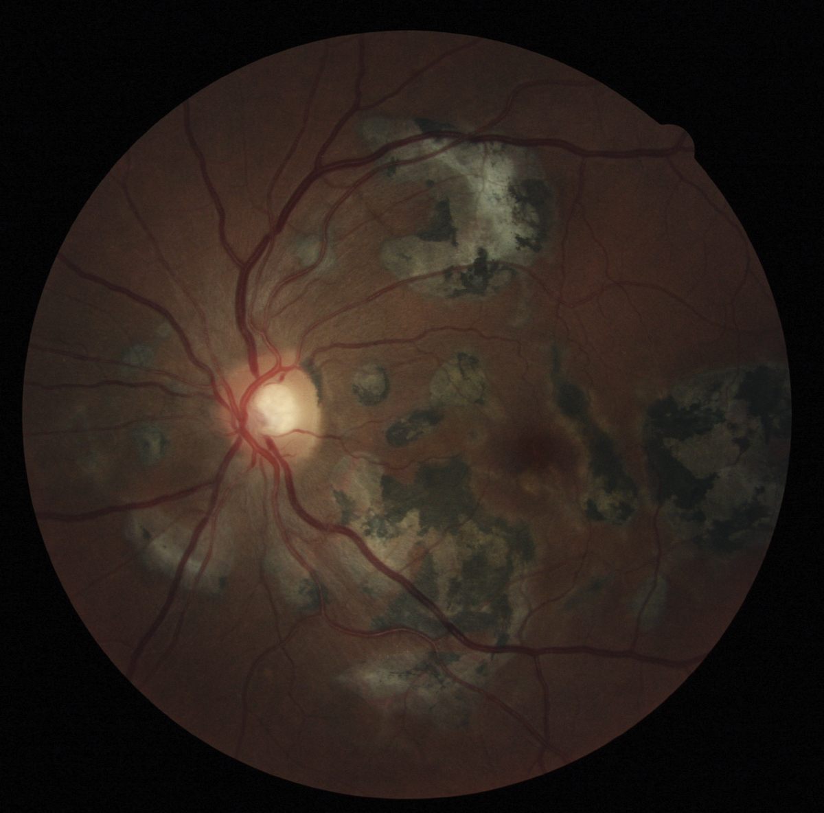 Fundus photograph of inactive serpiginous choroiditis shows retinal atrophy and RPE hyperpigmentation.