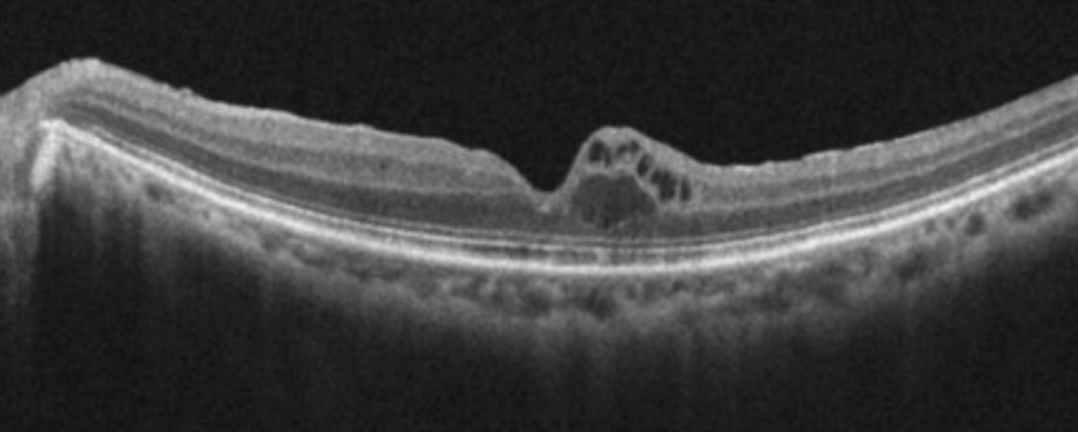 Cystoid macular edema, seen here using OCT, is frequently observed in uveitis patients.