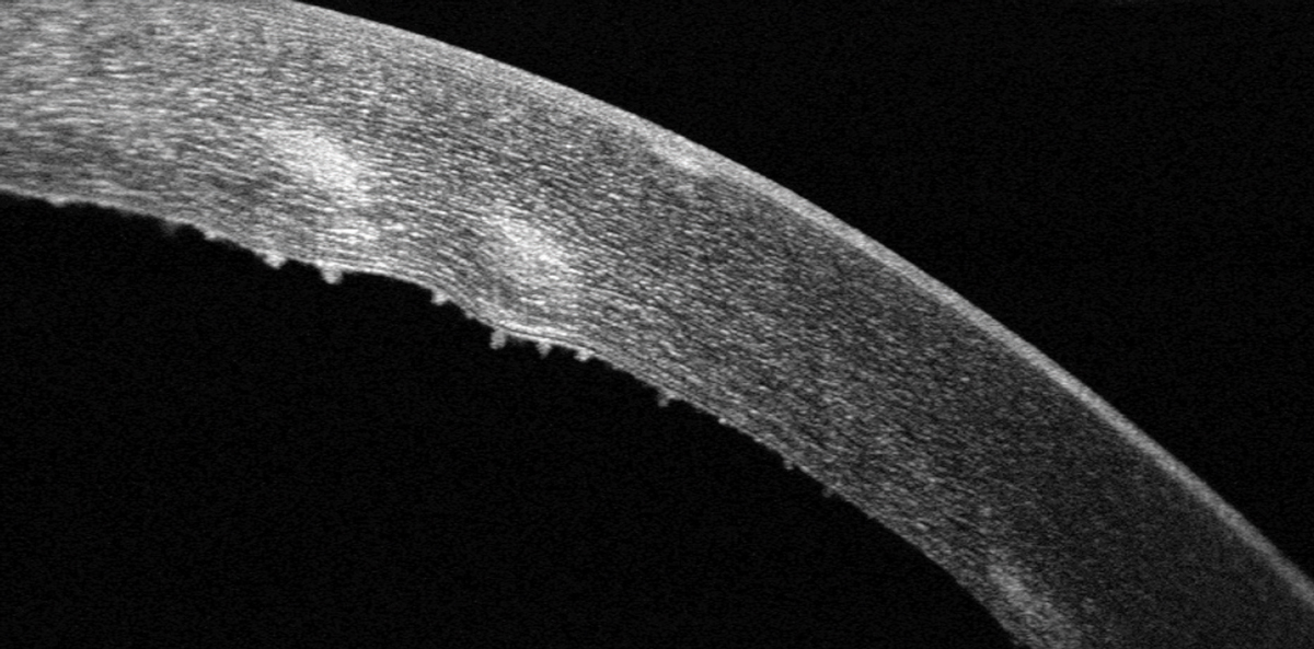 Keratic precipitates are visible on the corneal endothelium with SD-OCT imaging.
