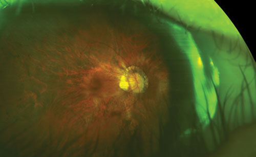 High levels of myopia (-5.00D or -6.00D or greater) increase the risk for ocular disease. Note the peripapillary atrophy and macular changes in this myopic eye.