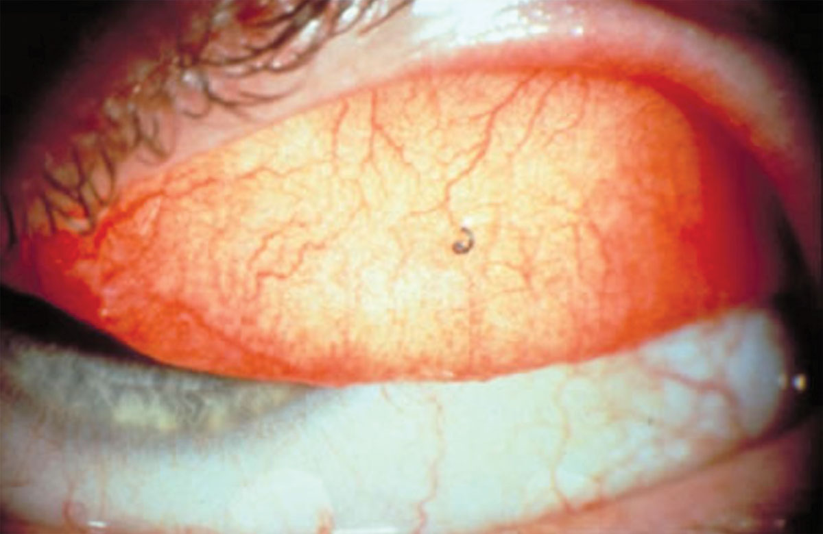 Fig. 2. Everting the lids can reveal a conjunctival foreign body.