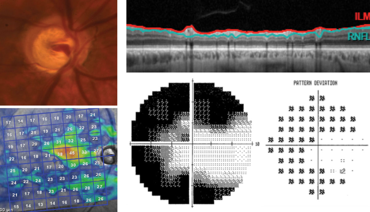 The right eye of this 65-year-old patient has severe stage glaucoma post-trabeculectomy. The segmentation scan, top right, shows no discernible RNFL thickness. The grayscale and pattern deviation plots, bottom right, show some remaining inferotemporal field on 10-2 testing. This corresponds well with the remaining superior nasal tissue found on isolated GCL analysis.