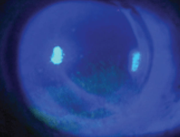 Superficial punctate keratitis is a possible finding associated with CAIs.