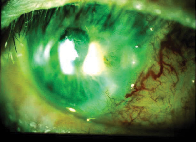 After a pterygiectomy with graft, a male patient in his 70s failed to use his medications and ocular lubricants. By one week post-op, he had developed descemetocele with adjacent infiltrates and positive Seidel sign. Corneal culture was positive for Staphylococcus. Fortified antibiotics cleared the infection while a full-thickness button graft repaired the descemetocele.