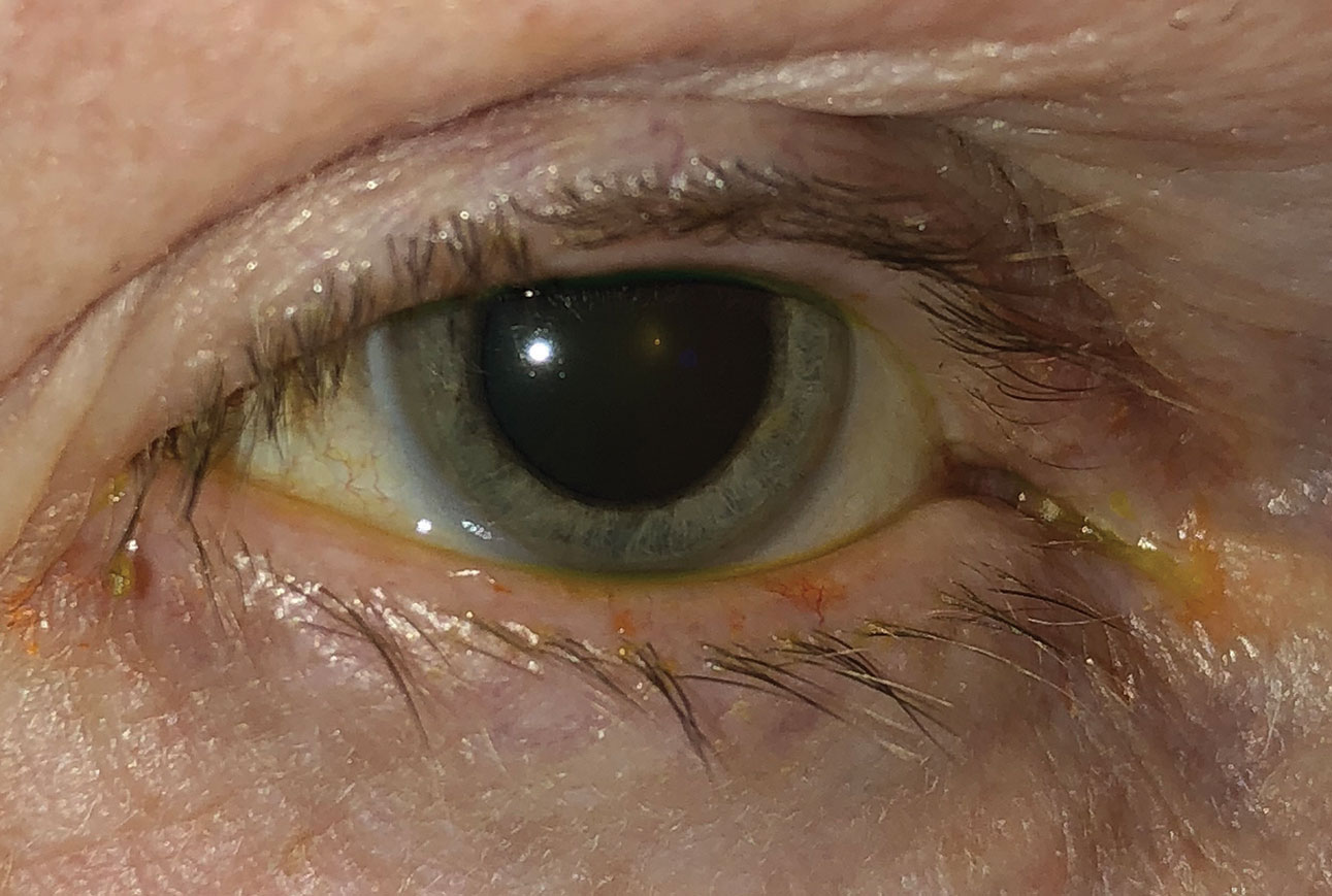 This patient has both ocular rosacea and dry eye.