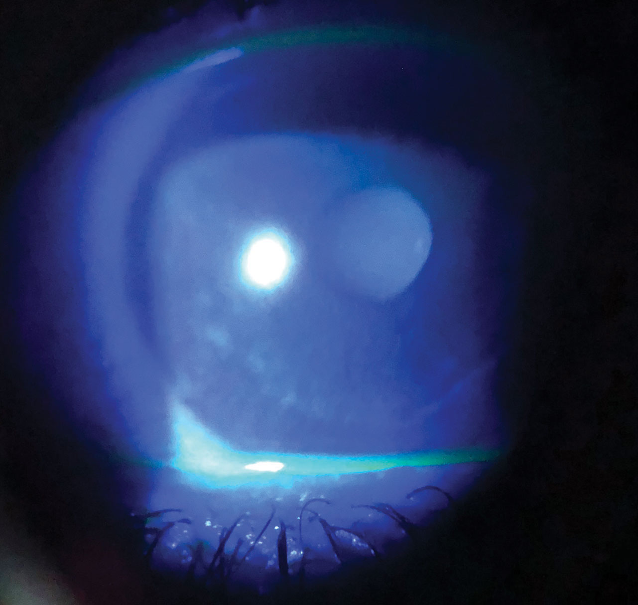 Dry eye in a patient with melanoma taking chemotherapeutic medications.