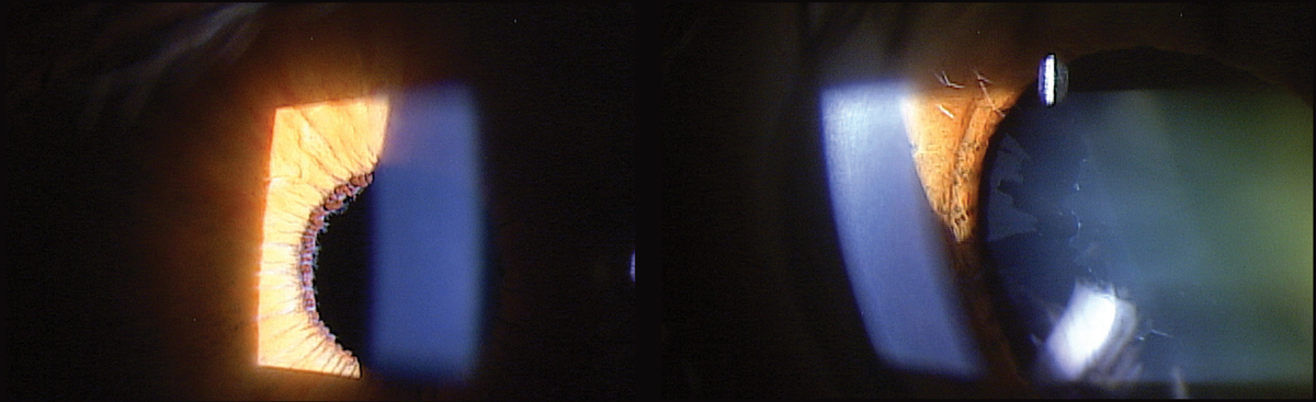 Fig. 1. At left, XFS material deposited on the pupillary margin of a 71-year-old patient diagnosed with XFS. At right, note the classic XFS pattern deposited on the anterior lens capsule.