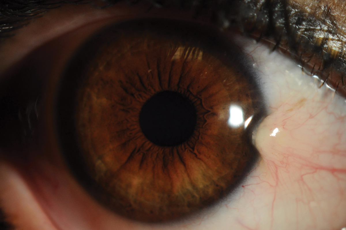Fig. 1. Pterygium is a wing-like or triangular raised centripetal lesion that grows from the conjunctiva onto the cornea.