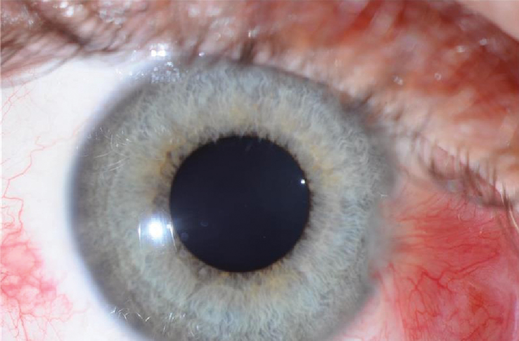 Fig. 2. Red appearance of eye due to angiogenesis in pterygium tissue.