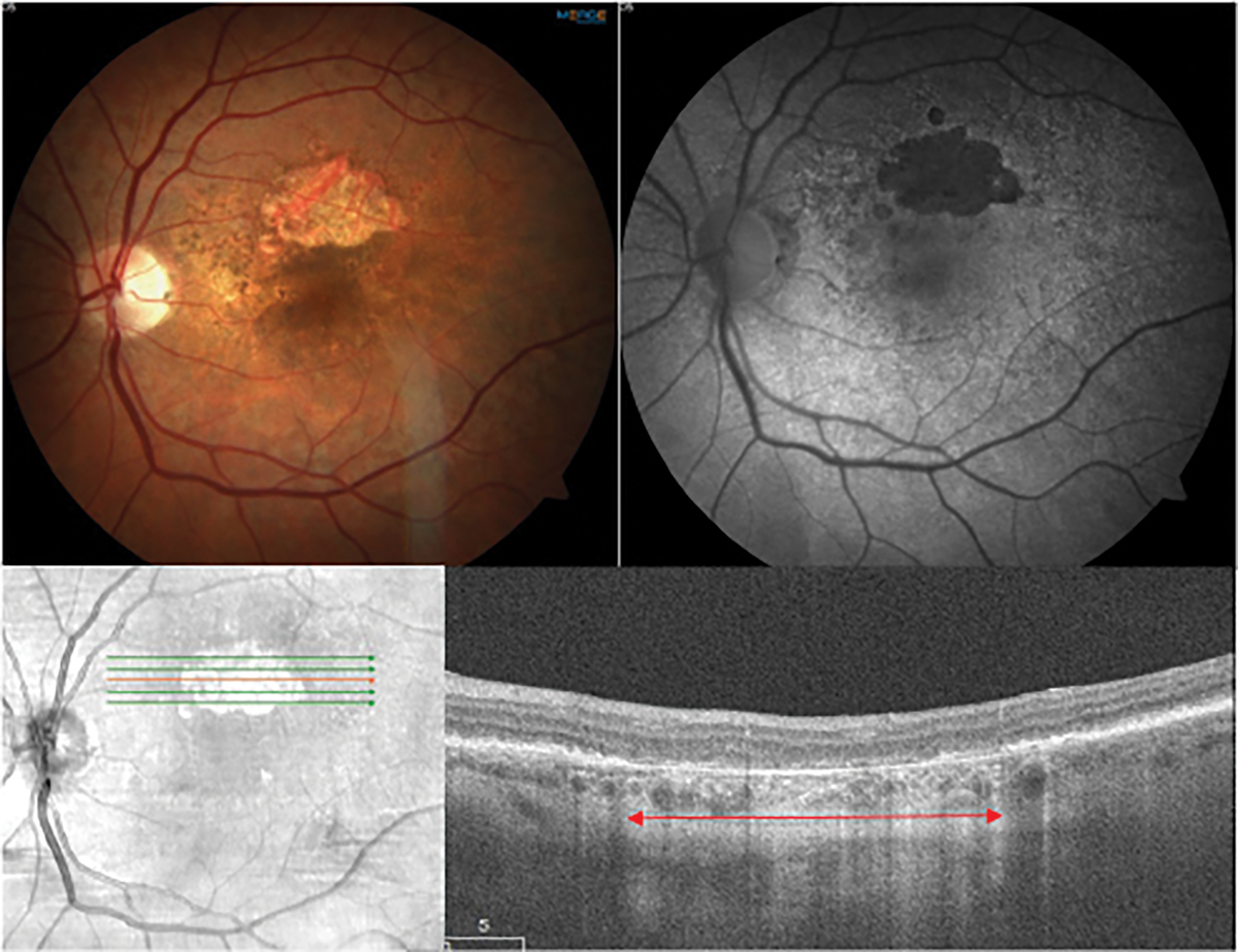 Fig. 1. Multimodal imaging of geographic atrophy. The top row shows a color fundus photo of a non-foveal island of GA in dry AMD and a fundus autofluorescence image in which the atrophy demonstrates classic hypoautofluorescence. The bottom row shows a near infrared image and an OCT scan through the GA lesion. There is a loss of ellipsoid zone and RPE in the outer retina and a choroidal hypertransmission defect (red arrow).