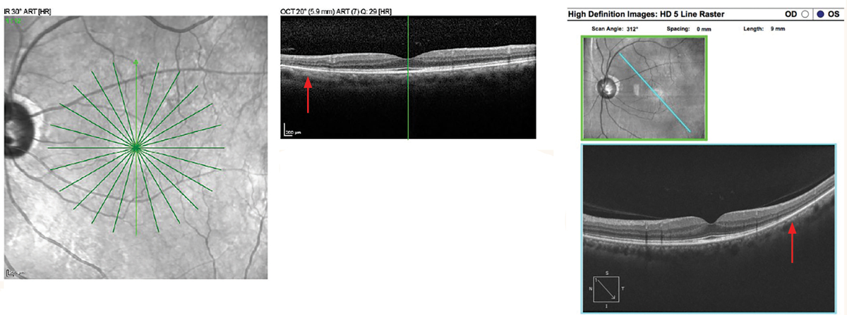 Hydroxychloroquine maculopathy with pericentral retinopathy. Spectralis SD-OCT Star scan (left image). Mild EZ disruption is present at the edge of the 6mm line scan inferiorly (top image). In the Cirrus HD 9mm line scan, note the loss of EZ inferotemporal in the pericentral retina (right images).