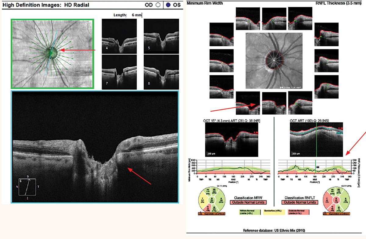 At left: Cirrus radial 6mm line scans of a thin superotemporal neuroretinal rim from glaucoma. At right: Spectralis BMO-MRW of a thin inferotemporal neuroretinal rim from glaucoma.