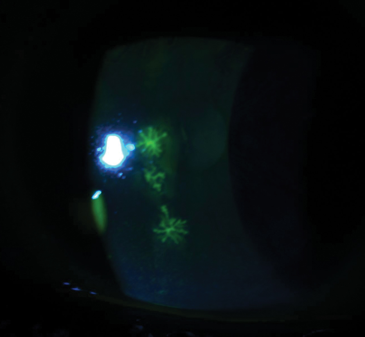 Fig. 4. This patient was diagnosed with acute herpes simplex keratitis, as these three elevated dendrites were stained with fluorescein.