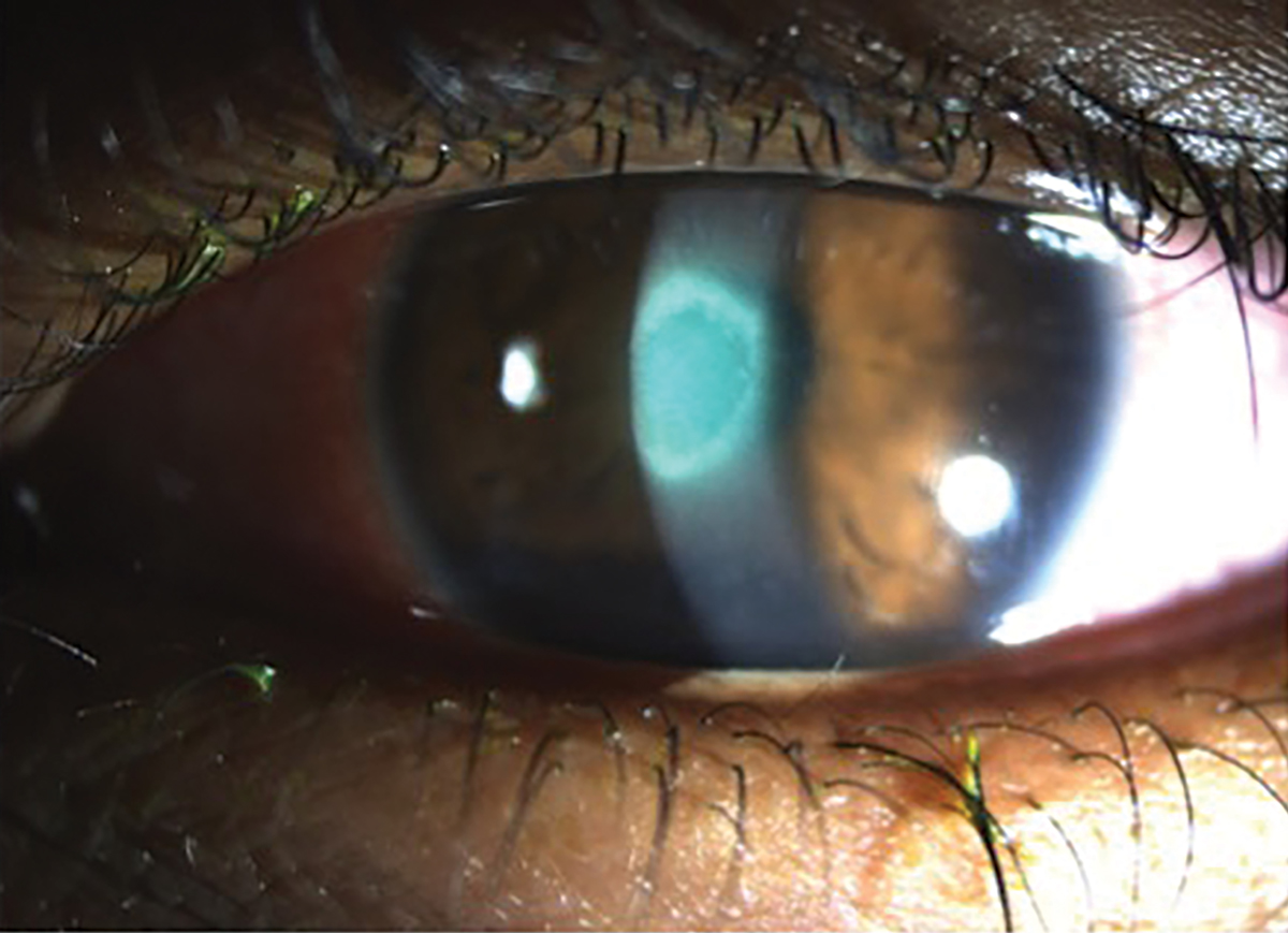 Fig. 6. A young patient presented with a new red and painful eye with light sensitivity secondary to bacterial keratitis from sleeping in monthly contact lenses.