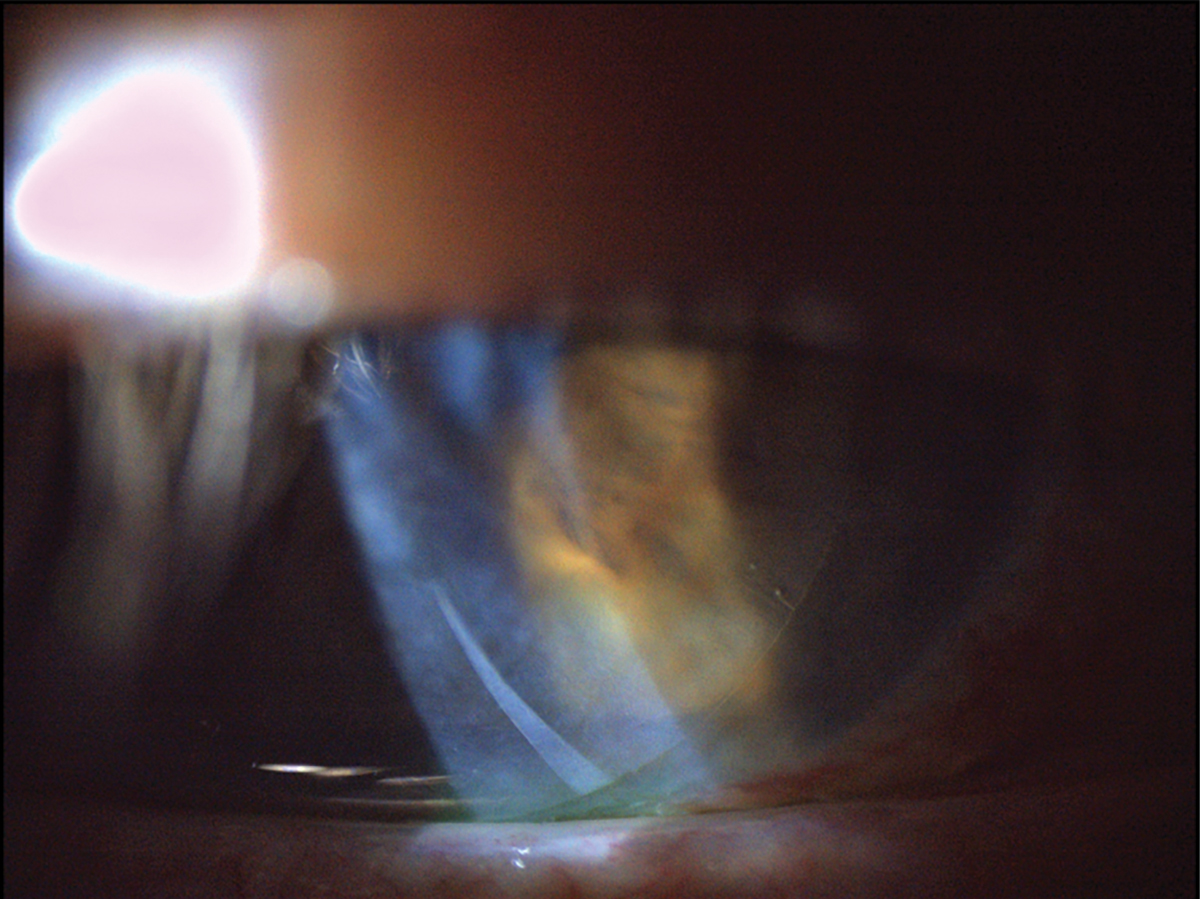 Fig. 7. This patient was fitted with a dehydrated amniotic membrane as seen underneath a bandage contact lens. There is mild folding of the dehydrated amniotic membrane as visible in the inferior cornea.